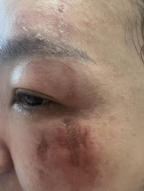 身上落这种小虫千万别拍 堪比泼强酸会灼伤皮肤(2)